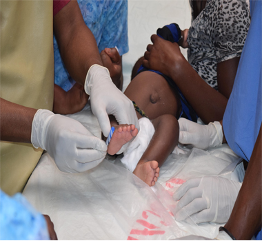 HÃ´pital Tertiaire HEAL Africa : MÃ©decins et Infirmiers en orthopÃ©die formÃ©s sur le counseling et le traitement de pieds-bots varus-equin (PBVE) selon la mÃ©thode de PONSETI
